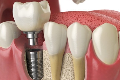 Odontopraxis Periodoncia 13