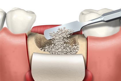 Odontopraxis Periodoncia 30