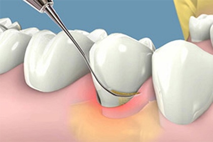 Odontopraxis Periodoncia 44